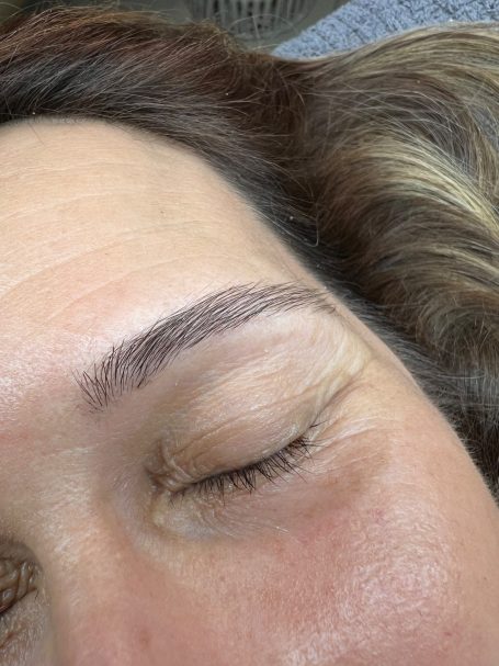 Referenzbild, Frau, Augenbrauenlifting, Browlifting