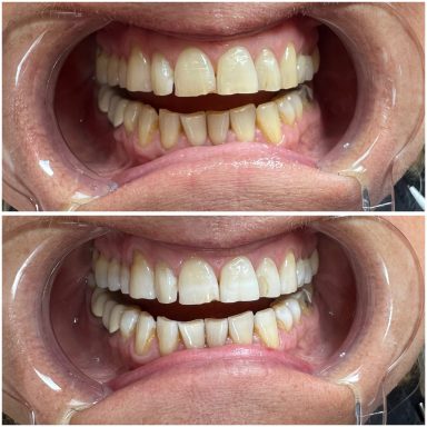 Referenzbild, kosmetisches Zahnbleaching, Frau