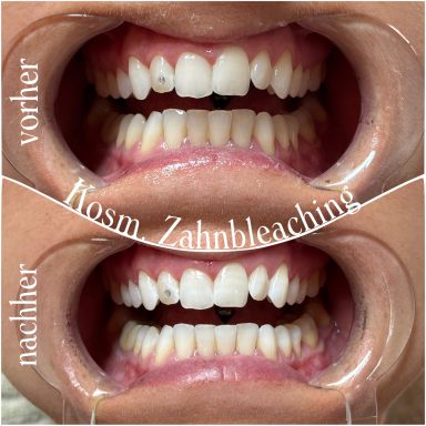Referenzbild, kosmetisches Zahnbleaching, Frau 30 Minuten.