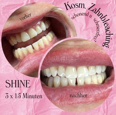 Referenzbild, kosmetisches Zahnbleaching, Frau nach 45 Minuten Behandlung 