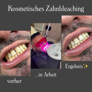 Testemonial-Fotoserie, kosmetisches Zahnbleaching Mann, vorher, Behandlung, Nachher.