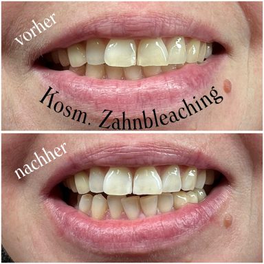 Referenzbild, kosmetisches Zahnbleaching, Frau nach 45 Minuten Behandlung.