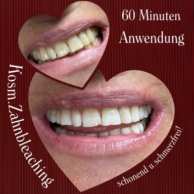 Testemonial-Foto, kosmetisches Zahnbleaching, Frau nach 60 Minuten Behandlung.
