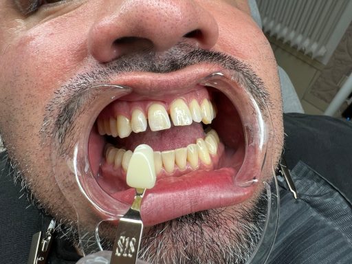 Farbanalyse kosmetisches Zahnbleaching, Mann