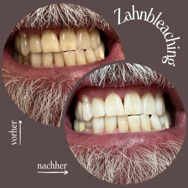 Testemonial-Foto, kosmetisches Zahnbleaching, Mann nach 60 Minuten Behandlung